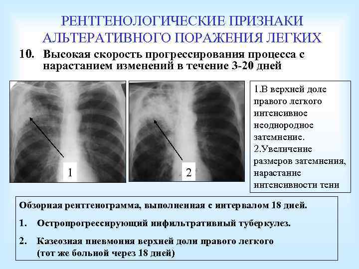 РЕНТГЕНОЛОГИЧЕСКИЕ ПРИЗНАКИ АЛЬТЕРАТИВНОГО ПОРАЖЕНИЯ ЛЕГКИХ 10. Высокая скорость прогрессирования процесса с нарастанием изменений в