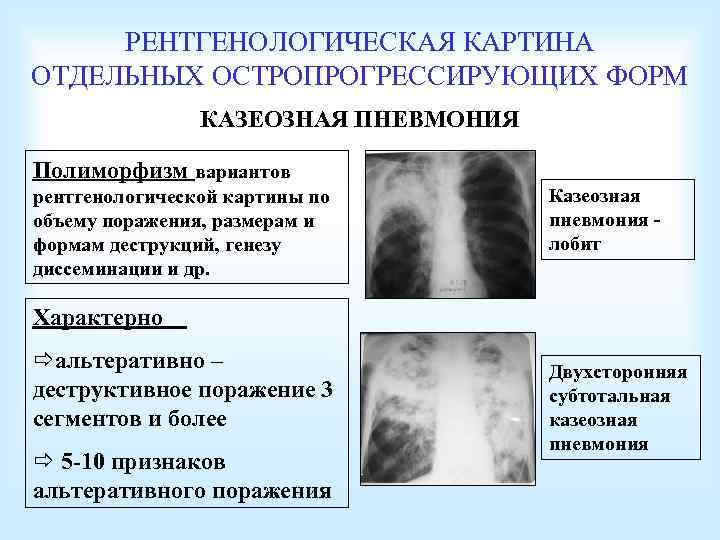 РЕНТГЕНОЛОГИЧЕСКАЯ КАРТИНА ОТДЕЛЬНЫХ ОСТРОПРОГРЕССИРУЮЩИХ ФОРМ КАЗЕОЗНАЯ ПНЕВМОНИЯ Полиморфизм вариантов рентгенологической картины по объему поражения,