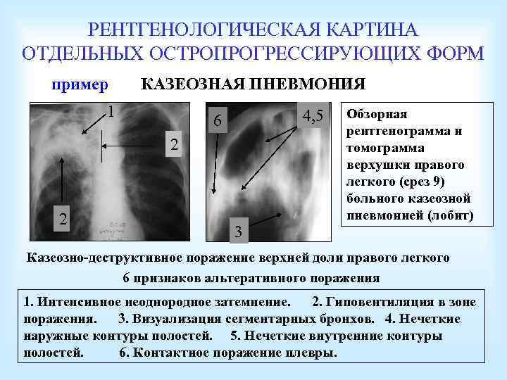 РЕНТГЕНОЛОГИЧЕСКАЯ КАРТИНА ОТДЕЛЬНЫХ ОСТРОПРОГРЕССИРУЮЩИХ ФОРМ пример КАЗЕОЗНАЯ ПНЕВМОНИЯ 1 4, 5 6 2 2
