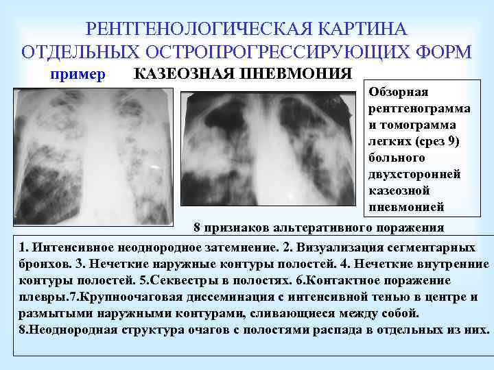 РЕНТГЕНОЛОГИЧЕСКАЯ КАРТИНА ОТДЕЛЬНЫХ ОСТРОПРОГРЕССИРУЮЩИХ ФОРМ пример КАЗЕОЗНАЯ ПНЕВМОНИЯ Обзорная рентгенограмма и томограмма легких (срез