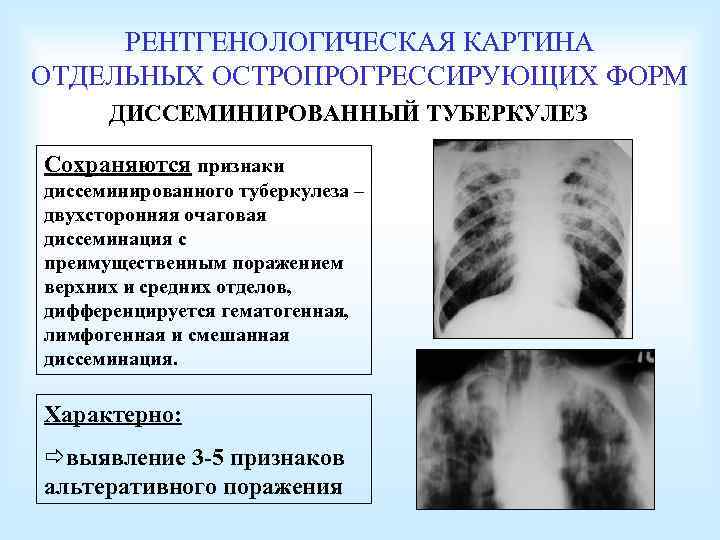 РЕНТГЕНОЛОГИЧЕСКАЯ КАРТИНА ОТДЕЛЬНЫХ ОСТРОПРОГРЕССИРУЮЩИХ ФОРМ ДИССЕМИНИРОВАННЫЙ ТУБЕРКУЛЕЗ Сохраняются признаки диссеминированного туберкулеза – двухсторонняя очаговая