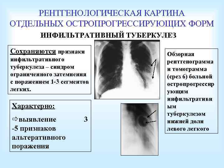 РЕНТГЕНОЛОГИЧЕСКАЯ КАРТИНА ОТДЕЛЬНЫХ ОСТРОПРОГРЕССИРУЮЩИХ ФОРМ ИНФИЛЬТРАТИВНЫЙ ТУБЕРКУЛЕЗ Сохраняются признаки инфильтративного туберкулеза – синдром ограниченного