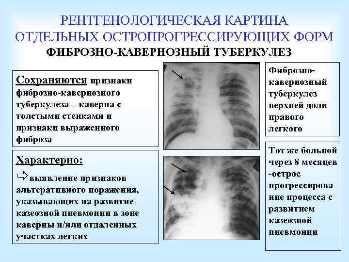 РЕНТГЕНОЛОГИЧЕСКАЯ КАРТИНА ОТДЕЛЬНЫХ ОСТРОПРОГРЕССИРУЮЩИХ ФОРМ ФИБРОЗНО-КАВЕРНОЗНЫЙ ТУБЕРКУЛЕЗ Сохраняются признаки фиброзно-кавернозного туберкулеза – каверна с