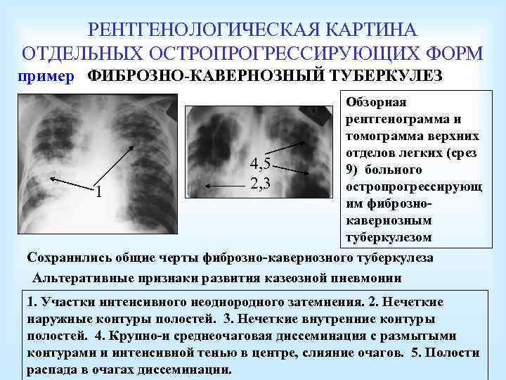 РЕНТГЕНОЛОГИЧЕСКАЯ КАРТИНА ОТДЕЛЬНЫХ ОСТРОПРОГРЕССИРУЮЩИХ ФОРМ пример ФИБРОЗНО-КАВЕРНОЗНЫЙ ТУБЕРКУЛЕЗ Обзорная рентгенограмма и томограмма верхних отделов