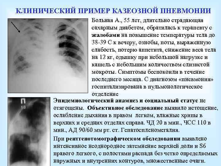 КЛИНИЧЕСКИЙ ПРИМЕР КАЗЕОЗНОЙ ПНЕВМОНИИ Больная А. , 55 лет, длительно страдающая сахарным диабетом, обратилась