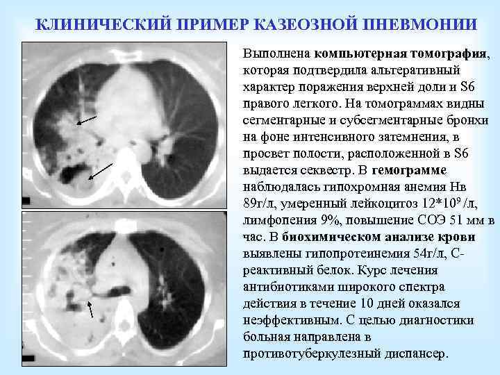 КЛИНИЧЕСКИЙ ПРИМЕР КАЗЕОЗНОЙ ПНЕВМОНИИ Выполнена компьютерная томография, которая подтвердила альтеративный характер поражения верхней доли