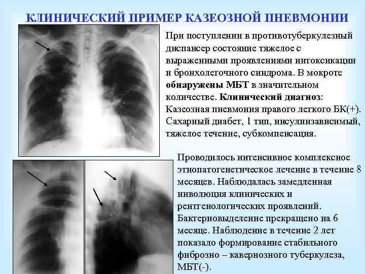 КЛИНИЧЕСКИЙ ПРИМЕР КАЗЕОЗНОЙ ПНЕВМОНИИ При поступлении в противотуберкулезный диспансер состояние тяжелое с выраженными проявлениями