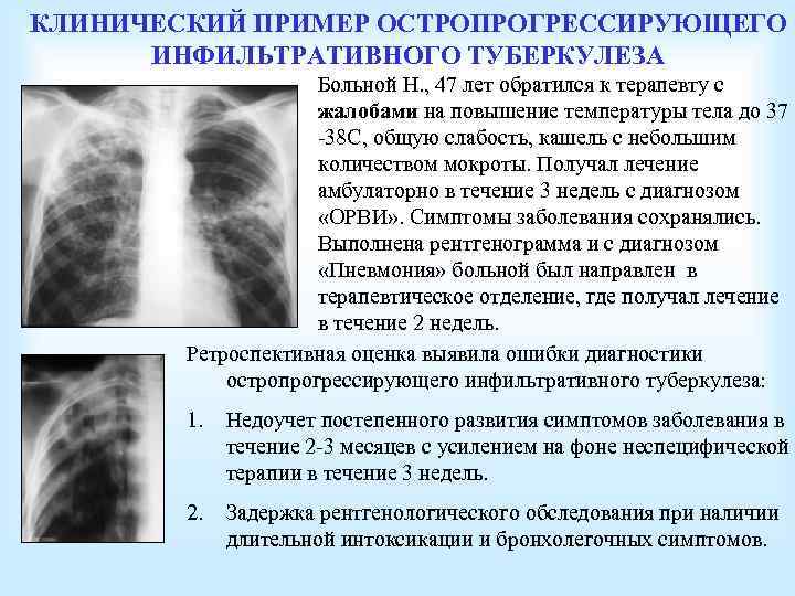КЛИНИЧЕСКИЙ ПРИМЕР ОСТРОПРОГРЕССИРУЮЩЕГО ИНФИЛЬТРАТИВНОГО ТУБЕРКУЛЕЗА Больной Н. , 47 лет обратился к терапевту с