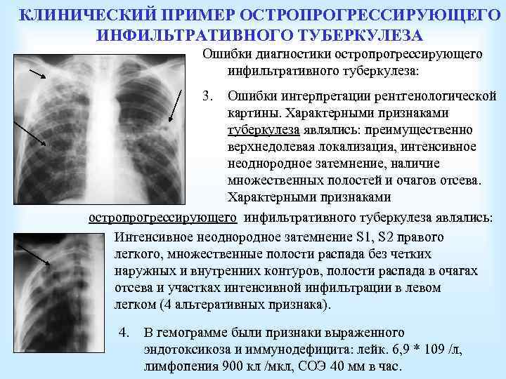 КЛИНИЧЕСКИЙ ПРИМЕР ОСТРОПРОГРЕССИРУЮЩЕГО ИНФИЛЬТРАТИВНОГО ТУБЕРКУЛЕЗА Ошибки диагностики остропрогрессирующего инфильтративного туберкулеза: 3. Ошибки интерпретации рентгенологической