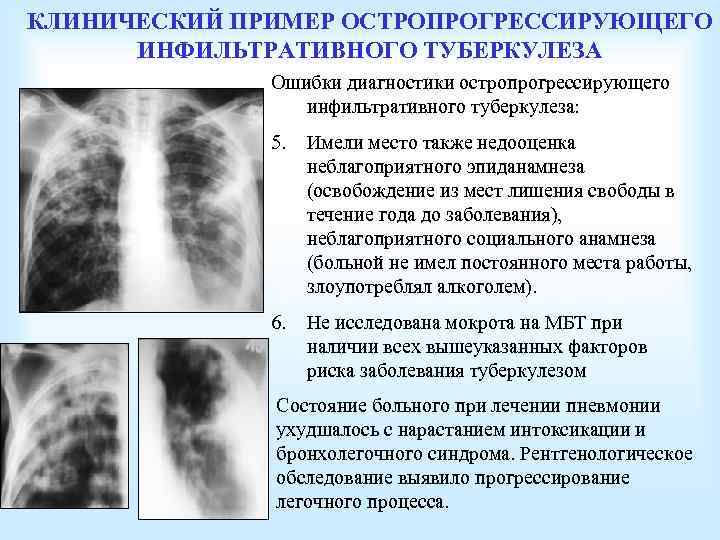КЛИНИЧЕСКИЙ ПРИМЕР ОСТРОПРОГРЕССИРУЮЩЕГО ИНФИЛЬТРАТИВНОГО ТУБЕРКУЛЕЗА Ошибки диагностики остропрогрессирующего инфильтративного туберкулеза: 5. Имели место также