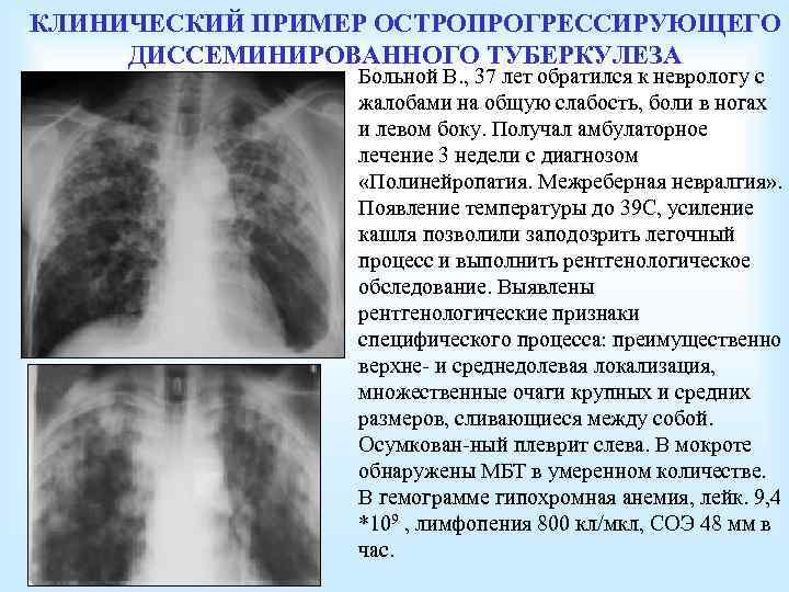 КЛИНИЧЕСКИЙ ПРИМЕР ОСТРОПРОГРЕССИРУЮЩЕГО ДИССЕМИНИРОВАННОГО ТУБЕРКУЛЕЗА Больной В. , 37 лет обратился к неврологу с