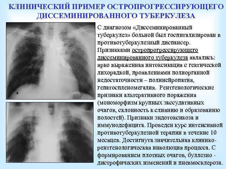 КЛИНИЧЕСКИЙ ПРИМЕР ОСТРОПРОГРЕССИРУЮЩЕГО ДИССЕМИНИРОВАННОГО ТУБЕРКУЛЕЗА С диагнозом «Диссеминированный туберкулез» больной был госпитализирован в противотуберкулезный