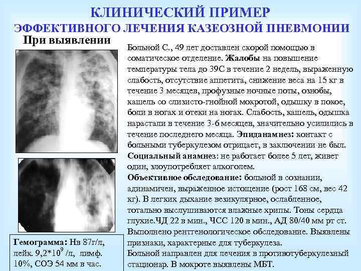 КЛИНИЧЕСКИЙ ПРИМЕР ЭФФЕКТИВНОГО ЛЕЧЕНИЯ КАЗЕОЗНОЙ ПНЕВМОНИИ При выявлении Гемограмма: Нв 87 г/л, лейк. 9,