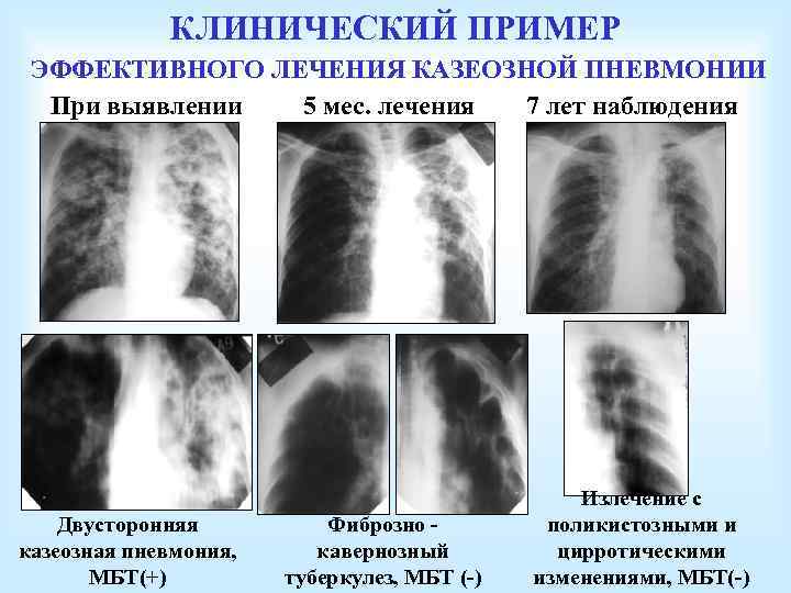 КЛИНИЧЕСКИЙ ПРИМЕР ЭФФЕКТИВНОГО ЛЕЧЕНИЯ КАЗЕОЗНОЙ ПНЕВМОНИИ При выявлении 5 мес. лечения 7 лет наблюдения