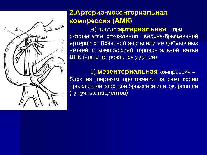 2. Артерио-мезентериальная компрессия (АМК) а) чистая артериальная – при остром угле отхождения верхне-брыжеечной артерии
