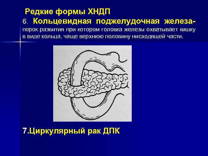 Редкие формы ХНДП 6. Кольцевидная поджелудочная железапорок развития при котором головка железы охватывает кишку