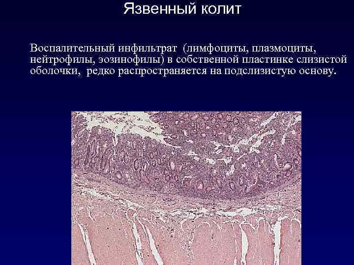 Воспалительный инфильтрат