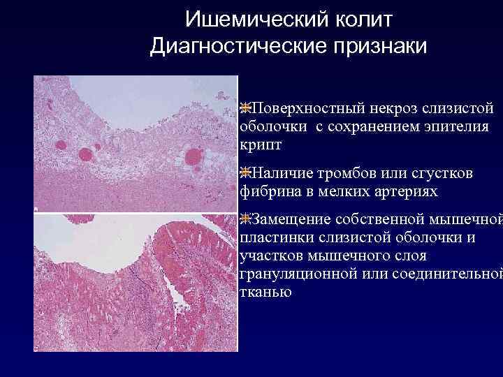 Поверхностный колит. Псевдомембранозный колит патанатомия. Псевдомембранозный колит гистология. Псевдомембранозный колит патологическая анатомия. Псевдомембранозный колит микропрепарат.