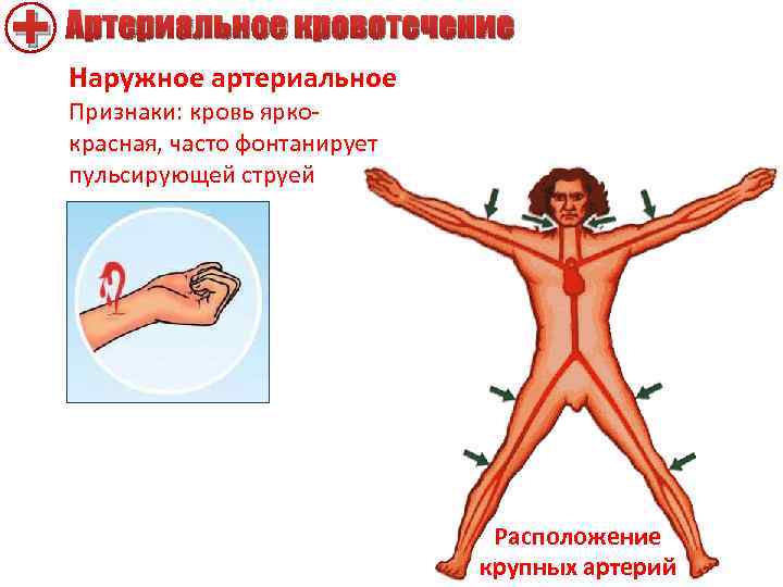 + Наружное артериальное Артериальное кровотечение Признаки: кровь яркокрасная, часто фонтанирует пульсирующей струей Расположение крупных
