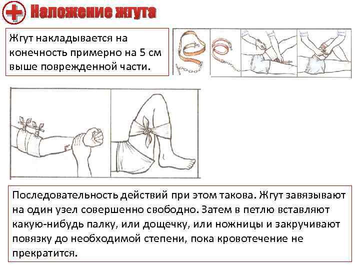 + Наложение жгута Жгут накладывается на конечность примерно на 5 см выше поврежденной части.