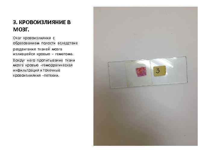 3. КРОВОИЗЛИЯНИЕ В МОЗГ. Очаг кровоизлияния с образованием полости вследствие раздвигания тканей мозга излившейся