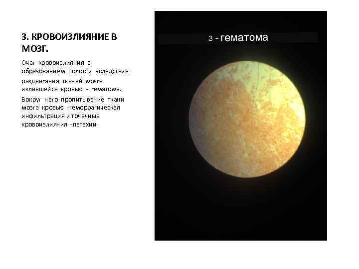 3. КРОВОИЗЛИЯНИЕ В МОЗГ. Очаг кровоизлияния с образованием полости вследствие раздвигания тканей мозга излившейся