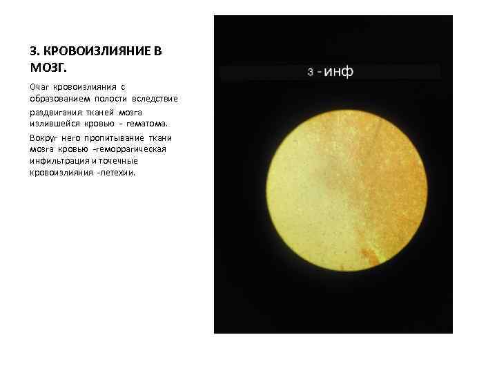 3. КРОВОИЗЛИЯНИЕ В МОЗГ. Очаг кровоизлияния с образованием полости вследствие раздвигания тканей мозга излившейся