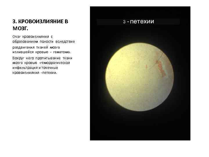 3. КРОВОИЗЛИЯНИЕ В МОЗГ. Очаг кровоизлияния с образованием полости вследствие раздвигания тканей мозга излившейся