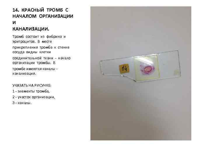 14. КРАСНЫЙ ТРОМБ С НАЧАЛОМ ОРГАНИЗАЦИИ И КАНАЛИЗАЦИИ. Тромб состоит из фибрина и эритроцитов.