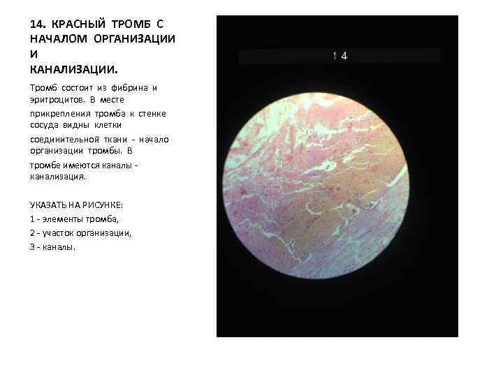 14. КРАСНЫЙ ТРОМБ С НАЧАЛОМ ОРГАНИЗАЦИИ И КАНАЛИЗАЦИИ. Тромб состоит из фибрина и эритроцитов.