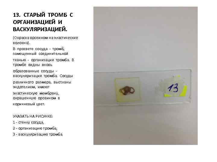 13. СТАРЫЙ ТРОМБ С ОРГАНИЗАЦИЕЙ И ВАСКУЛЯРИЗАЦИЕЙ. (Окраска орсеином на эластические волокна). В просвете