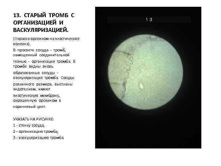 13. СТАРЫЙ ТРОМБ С ОРГАНИЗАЦИЕЙ И ВАСКУЛЯРИЗАЦИЕЙ. (Окраска орсеином на эластические волокна). В просвете