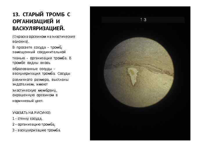 13. СТАРЫЙ ТРОМБ С ОРГАНИЗАЦИЕЙ И ВАСКУЛЯРИЗАЦИЕЙ. (Окраска орсеином на эластические волокна). В просвете