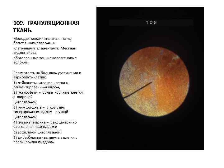 109. ГРАНУЛЯЦИОННАЯ ТКАНЬ. Молодая соединительная ткань, богатая капиллярами и клеточными элементами. Местами видны вновь