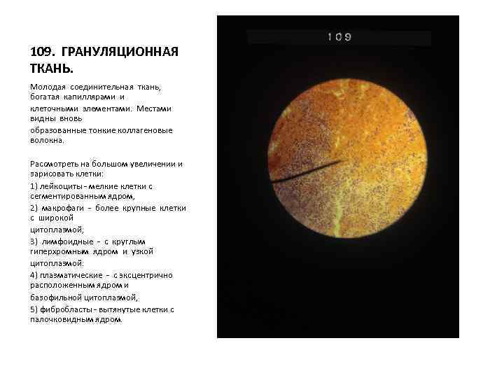 109. ГРАНУЛЯЦИОННАЯ ТКАНЬ. Молодая соединительная ткань, богатая капиллярами и клеточными элементами. Местами видны вновь