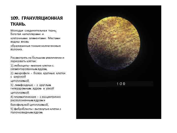109. ГРАНУЛЯЦИОННАЯ ТКАНЬ. Молодая соединительная ткань, богатая капиллярами и клеточными элементами. Местами видны вновь