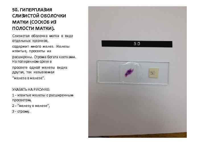 50. ГИПЕРПЛАЗИЯ СЛИЗИСТОЙ ОБОЛОЧКИ МАТКИ (СОСКОБ ИЗ ПОЛОСТИ МАТКИ). Слизистая оболочка матки в виде