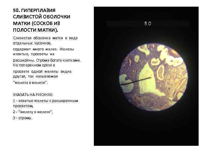 50. ГИПЕРПЛАЗИЯ СЛИЗИСТОЙ ОБОЛОЧКИ МАТКИ (СОСКОБ ИЗ ПОЛОСТИ МАТКИ). Слизистая оболочка матки в виде