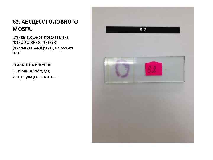 62. АБСЦЕСС ГОЛОВНОГО МОЗГА. Стенка абсцесса представлена грануляционной тканью (пиогенная мембрана), в просвете гной.