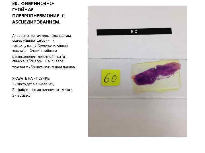 60. ФИБРИНОЗНОГНОЙНАЯ ПЛЕВРОПНЕВМОНИЯ С АБСЦЕДИРОВАНИЕМ. Альвеолы заполнены экссудатом, содержащим фибрин и лейкоциты. В бронхах