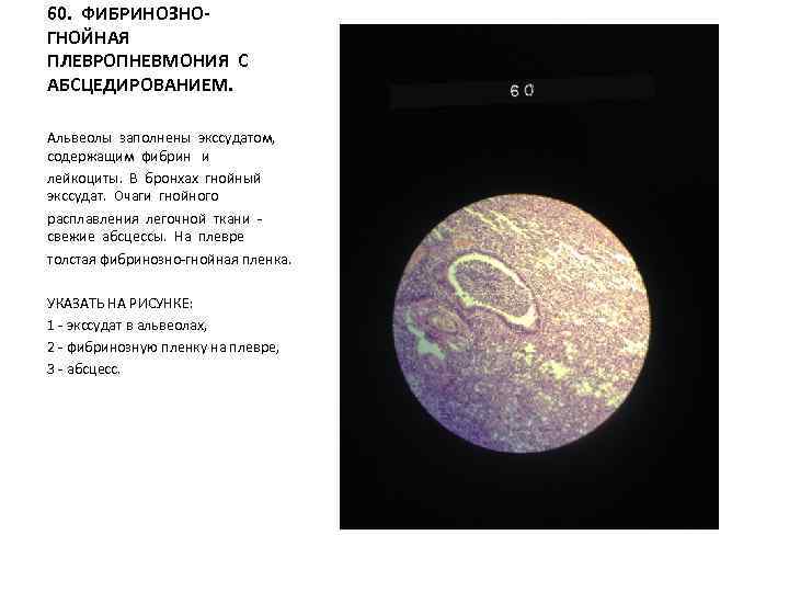 60. ФИБРИНОЗНОГНОЙНАЯ ПЛЕВРОПНЕВМОНИЯ С АБСЦЕДИРОВАНИЕМ. Альвеолы заполнены экссудатом, содержащим фибрин и лейкоциты. В бронхах