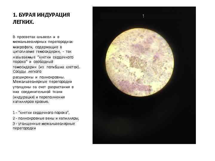 1. БУРАЯ ИНДУРАЦИЯ ЛЕГКИХ. В просветах альвеол и в межальвеолярных перегородках макрофаги, содержащие в