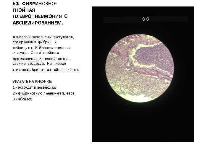 60. ФИБРИНОЗНОГНОЙНАЯ ПЛЕВРОПНЕВМОНИЯ С АБСЦЕДИРОВАНИЕМ. Альвеолы заполнены экссудатом, содержащим фибрин и лейкоциты. В бронхах