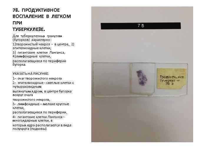 78. ПРОДУКТИВНОЕ ВОСПАЛЕНИЕ В ЛЕГКОМ ПРИ ТУБЕРКУЛЕЗЕ. Для туберкулезных гранулем (бугорков) характерно: 1)творожистый некроз