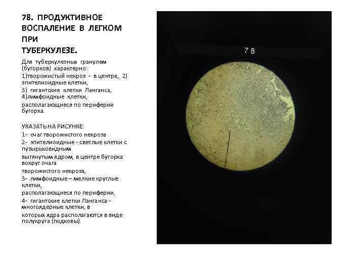 78. ПРОДУКТИВНОЕ ВОСПАЛЕНИЕ В ЛЕГКОМ ПРИ ТУБЕРКУЛЕЗЕ. Для туберкулезных гранулем (бугорков) характерно: 1)творожистый некроз