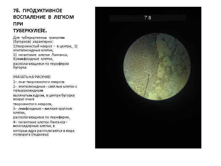 78. ПРОДУКТИВНОЕ ВОСПАЛЕНИЕ В ЛЕГКОМ ПРИ ТУБЕРКУЛЕЗЕ. Для туберкулезных гранулем (бугорков) характерно: 1)творожистый некроз
