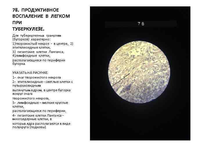 78. ПРОДУКТИВНОЕ ВОСПАЛЕНИЕ В ЛЕГКОМ ПРИ ТУБЕРКУЛЕЗЕ. Для туберкулезных гранулем (бугорков) характерно: 1)творожистый некроз