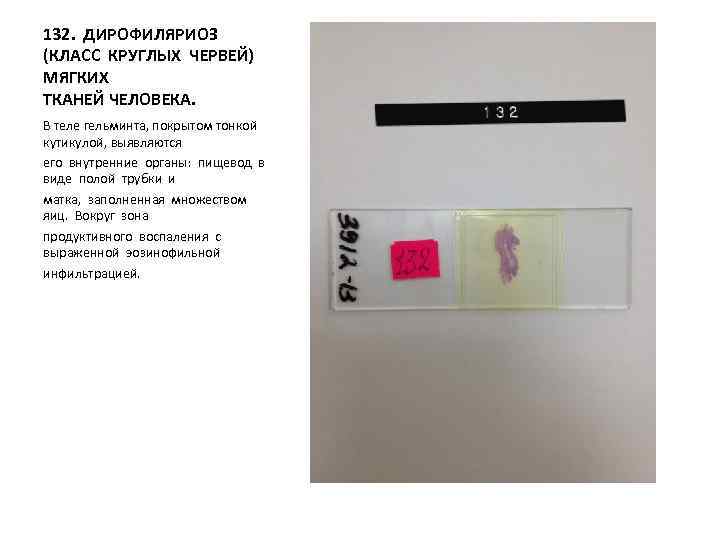 132. ДИРОФИЛЯРИОЗ (КЛАСС КРУГЛЫХ ЧЕРВЕЙ) МЯГКИХ ТКАНЕЙ ЧЕЛОВЕКА. В теле гельминта, покрытом тонкой кутикулой,