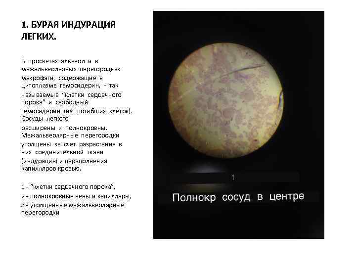 1. БУРАЯ ИНДУРАЦИЯ ЛЕГКИХ. В просветах альвеол и в межальвеолярных перегородках макрофаги, содержащие в