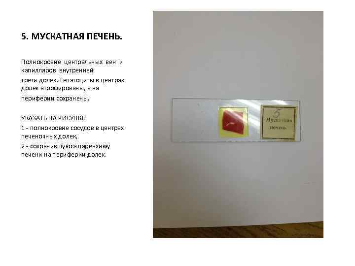 5. МУСКАТНАЯ ПЕЧЕНЬ. Полнокровие центральных вен и капилляров внутренней трети долек. Гепатоциты в центрах